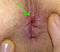 Fissurectomy wound 1,5 weeks after the OP