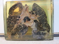 Silikoosin ja tuberkuloosin tuhoamat kaivosmiehen keuhkot. Basque Museum of the History of Medicine and Science.