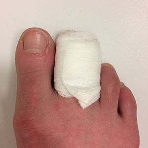 second and third toes wrapped in padding and a bandage, leaving the big toe free