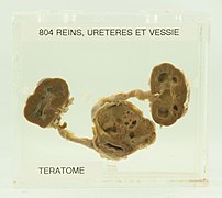 Vessie, Reins, Uretères Tératome (vue antérieure) 55-o.apatho-804a-reinvessie.jpg