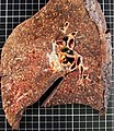 Gross pathology of lung