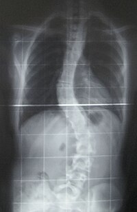 Röntgenkuva kieroutuneesta selkärangasta.