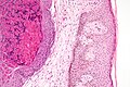 High-magnification micrograph of molluscum contagiosum, showing the characteristic molluscum bodies, H&E stain