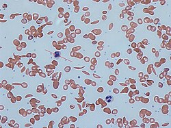 الخلايا المنجلية في دم الإنسان: كل من خلايا الدم الحمراء الطبيعية والخلايا المنجلية موجودة