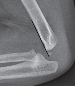 The anterior humeral line is not reliable in children with sparse ossification of the capitulum, such as in this 6 months old child.[9]