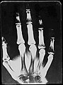 Original: X-Ray image of right Hand; 1st. order equidensities after pseudo-solarization of original