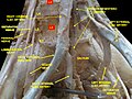 Lumbar and sacral plexus. Deep dissection.Anterior view.