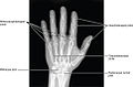 Joints of the hand in an X-ray image