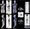 Normal whole body PET/CT scan with FDG-18. The whole body PET/CT scan is commonly used in the detection, staging and follow-up of various cancers.