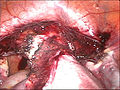 Laparoscopical hysterectomy