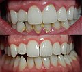 Thumbnail for Debridement (dental)