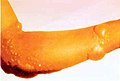 Chemical burns to the arm, caused by a blister agent e.g. mustard gas
