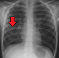 Right middle lobe pneumonia in a child as seen on plain X-ray
