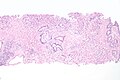 Micrograph of urethral urothelial cell carcinoma. H&E stain