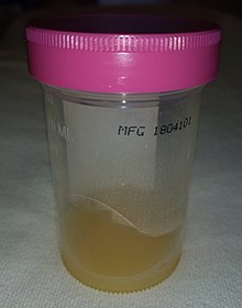 Exemple de liquide d'épanchement prélevé sur un genou infecté.