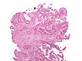 Cancer — Adenocarcinome invasif (le type le plus fréquent de cancer colorectal). Les cellules cancéreuses sont visibles (en bleu) au centre et en bas à droite de l'image (à comparer aux cellules normales visibles en haut à droite).