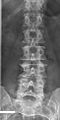 Lumbarization of sacral vertebra 1, seen as 6 vertebrae that do not connect to ribs.