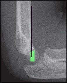 Anterior humeral line (black line), with normal area passed on the capitulum of the humerus colored in green in a 4 year old child.[9]
