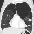 Very severe emphysema with lung cancer on the left (CT scan)