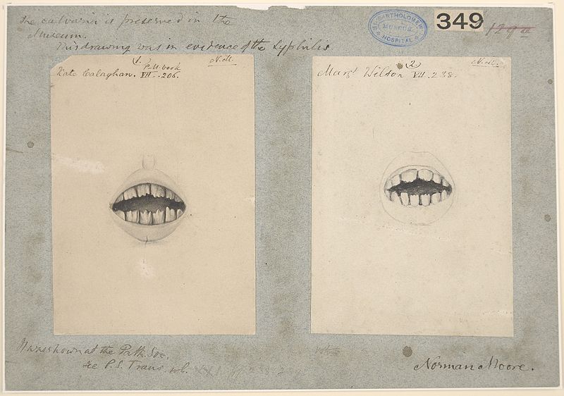 File:Teeth from two patients with congenital syphilis Wellcome L0061568.jpg
