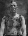 German American farmer John Meints of Minnesota was tarred and feathered in August 1918 for allegedly not supporting war bond drives.