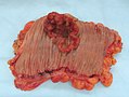 Apparence de l'intérieur d'un côlon développant un carcinome colorectal invasif (tumeur de forme irrégulière formant ici un cratère rougeâtre).