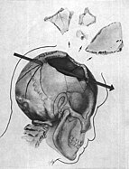 Sketch of the fatal bullet wound for president Kennedy