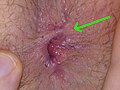 Fissurectomy wound 12,5 weeks after the OP