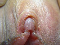 Normal human clitoral glans