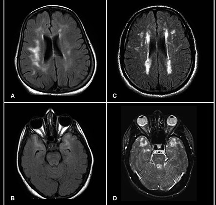 MRI demonstrating white matter changes in the brain of patients with CADASIL