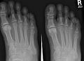 Zdjęcie rentgenowskie stopy