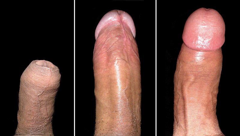 File:Ventral and Dorsal View of Penis.jpg