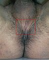 Muški perineum obilježen u kvadratu