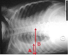 An X-ray showing a chest lying horizontal. The lower black area which is the right lung is smaller with a whiter area below it of a pulmonary effusion. There are red arrows marking the size of these.