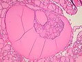 Thyroid hyperplasia with a Sanderson polster, which is a group of small follicles that protrude into the lumen of a larger follicle. It should not be confused for papillary projections.