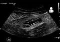 Ultrasound showing appendicitis and an appendicolith[57]