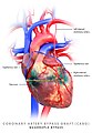 Coronary artery bypass graft, quadruple bypass