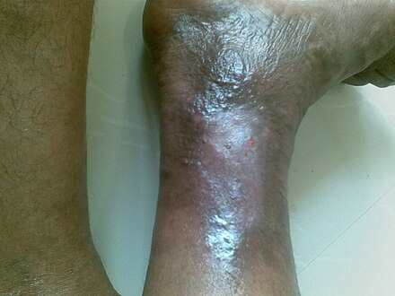Healing venous ulcer after one month