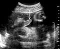 Echograph of fetus with penile erection