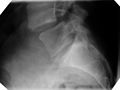 Imagen de rayos X de una anterolistesis ístmica de grado 1 en L4-5