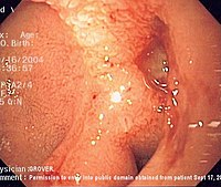 Endoscopic image of a posterior wall duodenal ulcer with a clean base, which is a common cause of upper GI hemorrhage.