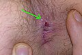 Fissurectomy wound 3,5 weeks after the OP