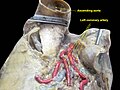 Left coronary artery. Plastination technique