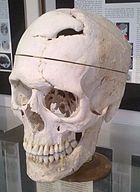 Gage's skull on display at the Warren Anatomical Museum