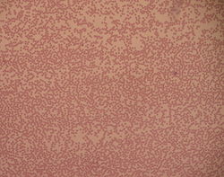 צילום של דם עם מחסור קיצוני של נויטרופילים, שנמצאים בו בעיקר תאי דם אדומים וטסיות דם.