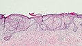 Fibroepitheliomatous pattern (anastomosing basaloid epithelial strands enclosing round islands of fibrous stroma)[34]