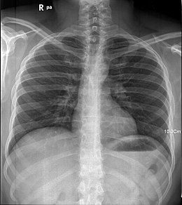 Röntgenfoto van menselijke longen