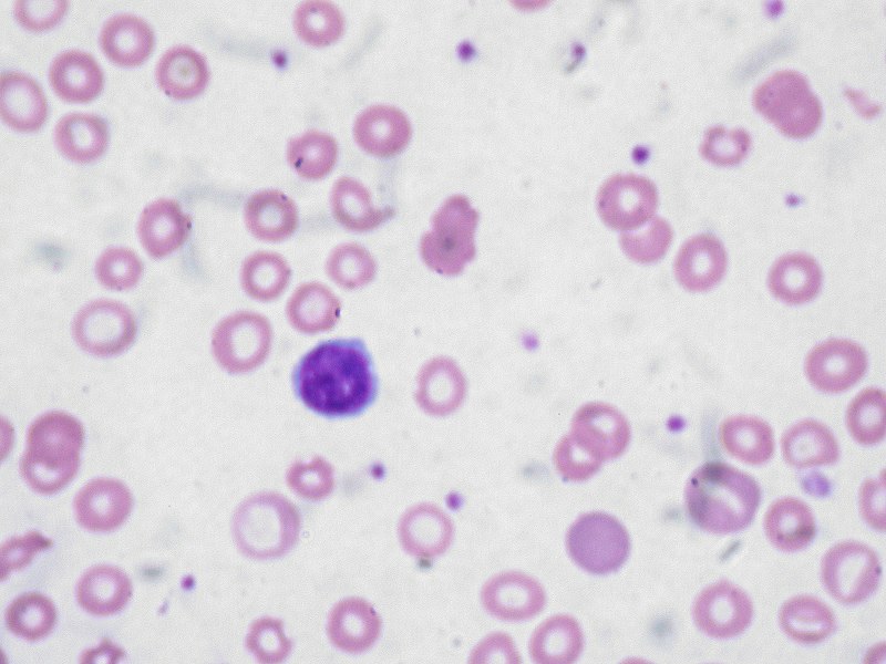 File:Iron deficiency anemia.jpg