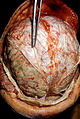 Agyhártyagyulladásban elhunyt beteg boncolásos vizsgálata. A fehéres hártya a kemény agyhártya. Alatta látható az agy felületének sárgás-zöldes gennyesedése.