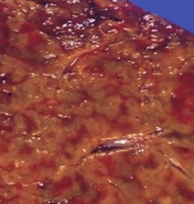 Nutmeg texture of congestive hepatopathy